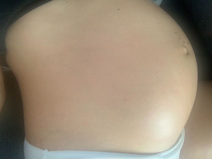 Embarazo y endometriosis - 1