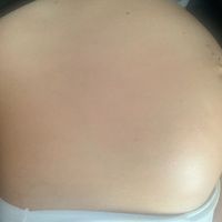 Embarazo y endometriosis - 1