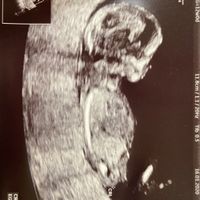 Ayuda con método ramzi: niño o niña? - 1