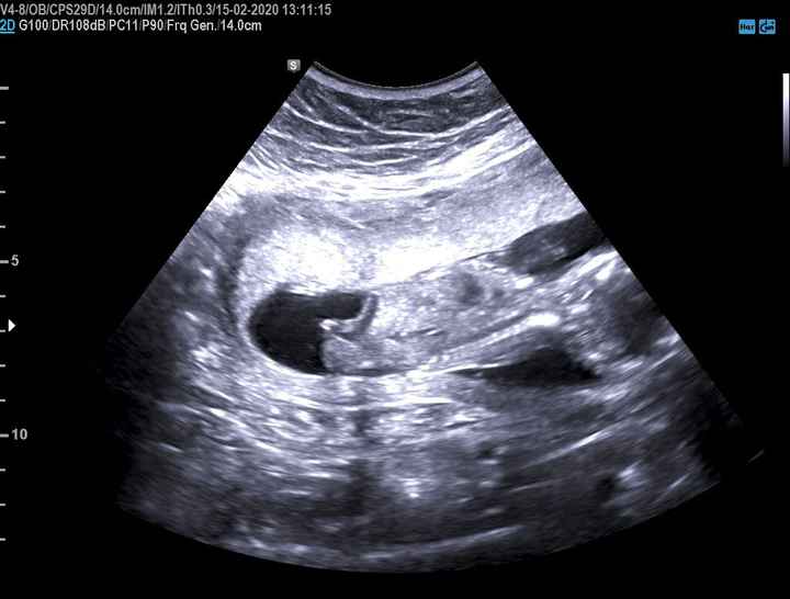 Tubérculo genital: niña - 1