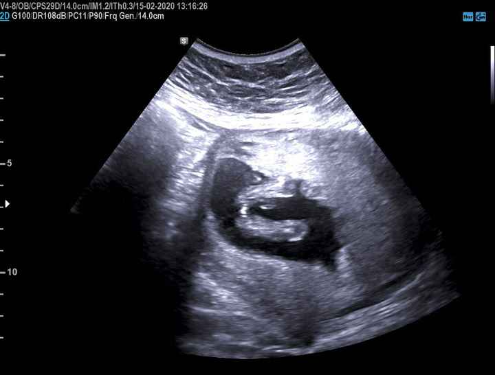 Tubérculo genital: niña - 2
