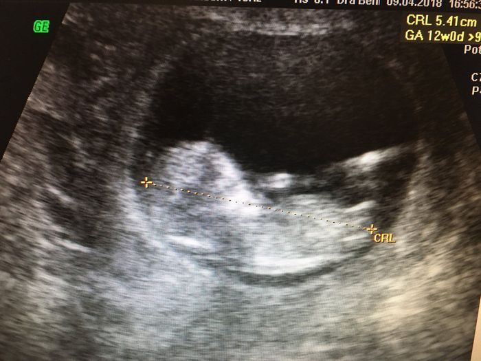 Tubérculo genital niño o niña??? 4