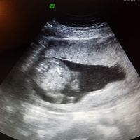 Ayuda con método ramzi: niño o niña? - 1