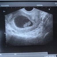 Ayuda con método ramzi: niño o niña? - 1