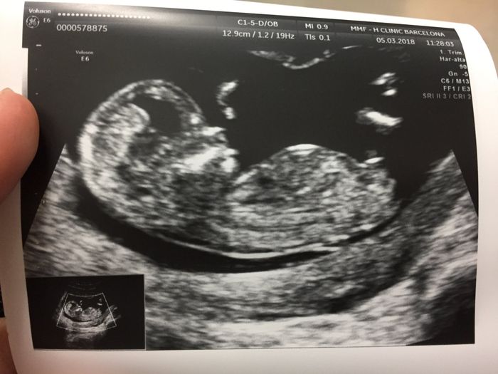 Tubérculo genital niño o niña??? 7