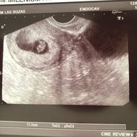 Ayuda con método ramzi: niño o niña? - 1