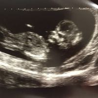 Ayuda con método ramzi: niño o niña? - 1