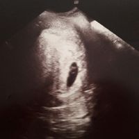 Ayuda con método ramzi: niño o niña? - 1