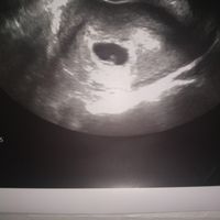 Ayuda con método ramzi: niño o niña? - 1