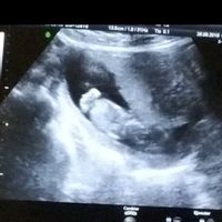 Ayuda con método ramzi: niño o niña? - 1