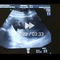 Tubérculo genital: niña - 1