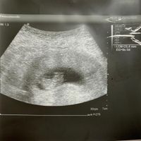 Ayuda con método ramzi: niño o niña? - 1