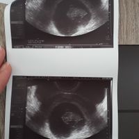 Ayuda con método ramzi: niño o niña? - 1