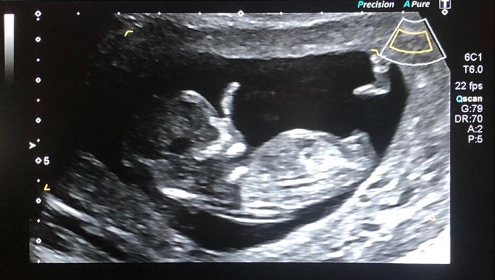 Tubérculo genital: niña - 1