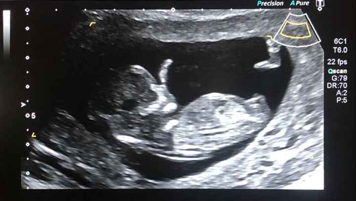 Tubérculo genital: niña 7