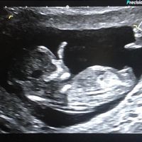 Tubérculo genital: niña - 1