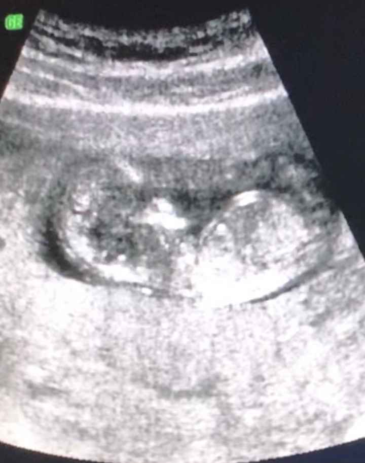 Ayuda con método ramzi: niño o niña? - 1