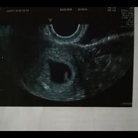 Ayuda con método ramzi: niño o niña? - 1