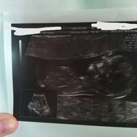 Ayuda con método ramzi: niño o niña? - 1