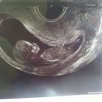 Ayuda con método ramzi: niño o niña? - 1