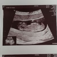 Ayuda con método ramzi: niño o niña? - 2