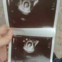 Ayuda con método ramzi: niño o niña? - 1