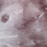 Ayuda con método ramzi: niño o niña? - 1