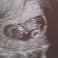 Ayuda con método ramzi: niño o niña? - 1