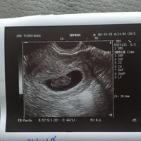 Ayuda con método ramzi: niño o niña? - 1