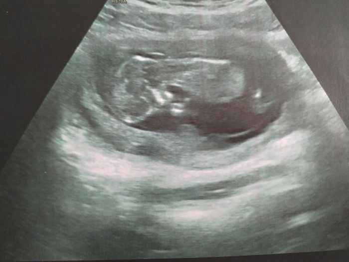Ayuda con método ramzi: niño o niña? - 1