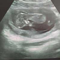Ayuda con método ramzi: niño o niña? - 1