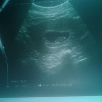 Ayuda con método ramzi: niño o niña? - 1