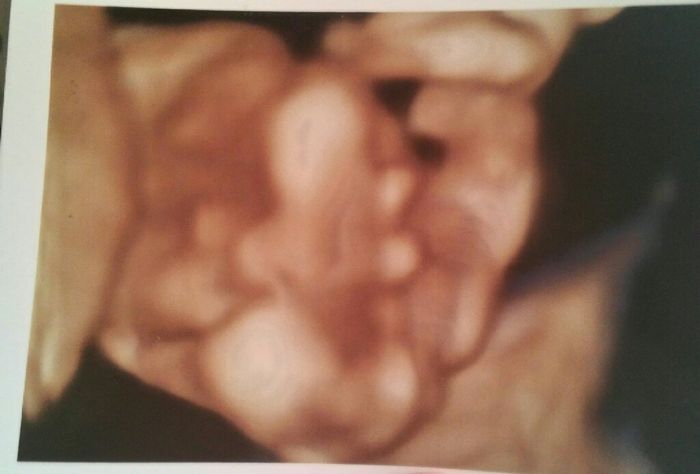 Tubérculo genital niño o niña??? 3