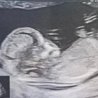 Ayuda con método ramzi: niño o niña? - 1