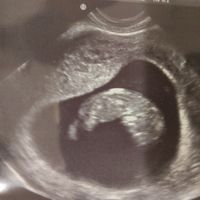 Ayuda con método ramzi: niño o niña? - 1