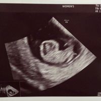 Ayuda con método ramzi: niño o niña? - 1