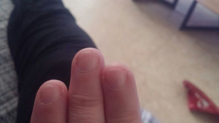 Remedio para no morderse las uñas. - 1