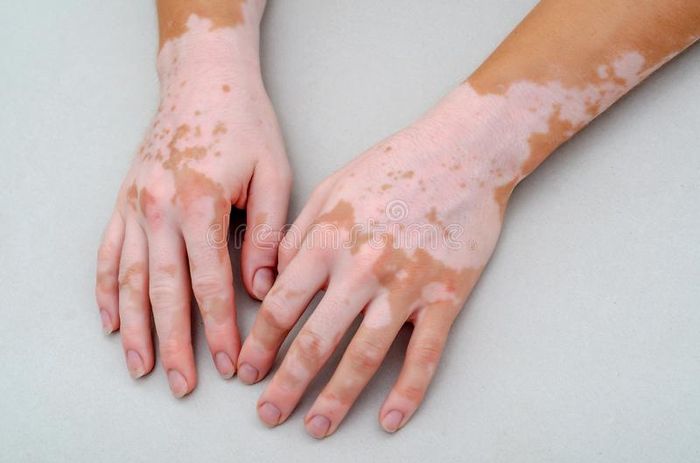 ¿Guantes sí o no? Novia con vitíligo en las manos 7