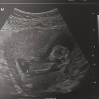 Ayuda con método ramzi: niño o niña? - 1