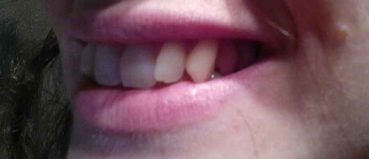 Aparato de dientes sí o no? - 1