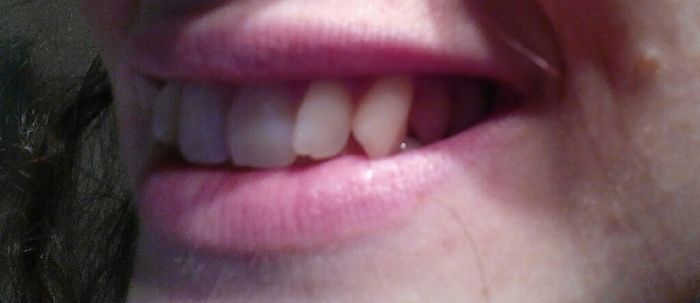 Aparato de dientes sí o no? - 1