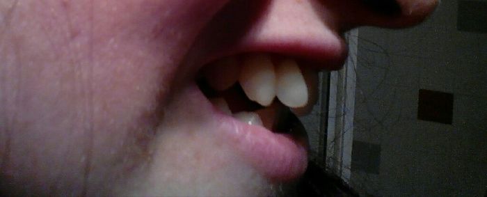 Aparato de dientes sí o no? - 2
