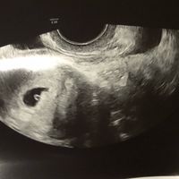 Ayuda con método ramzi: niño o niña? - 1