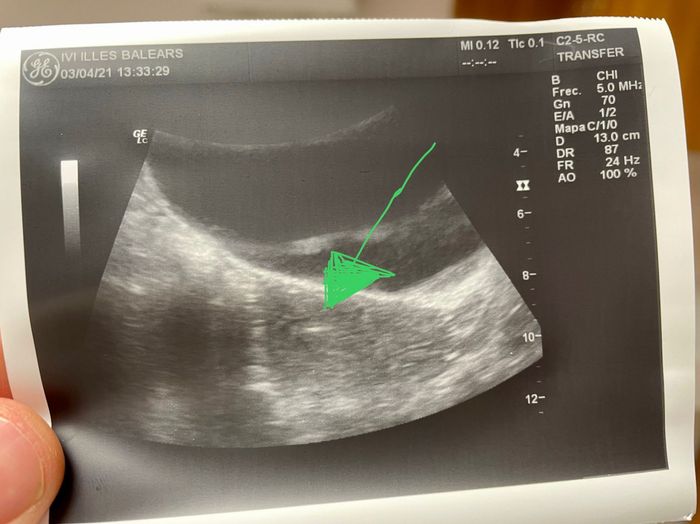 Proceso tratamiento fiv - 1
