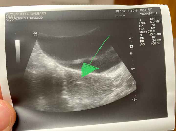 Proceso tratamiento fiv - 1