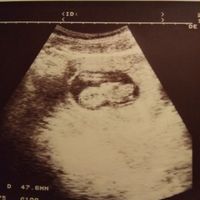 Ayuda con método ramzi: niño o niña? - 1