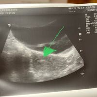Proceso tratamiento fiv - 1