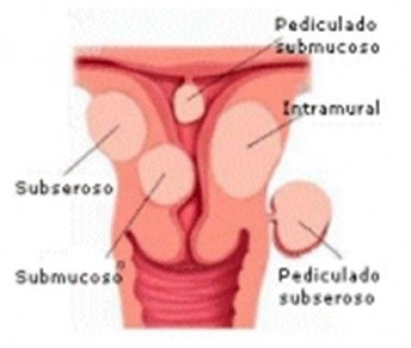 Tipos de míomas