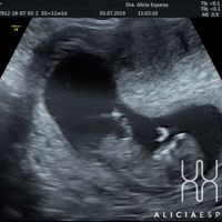 Ayuda con método ramzi: niño o niña? - 1