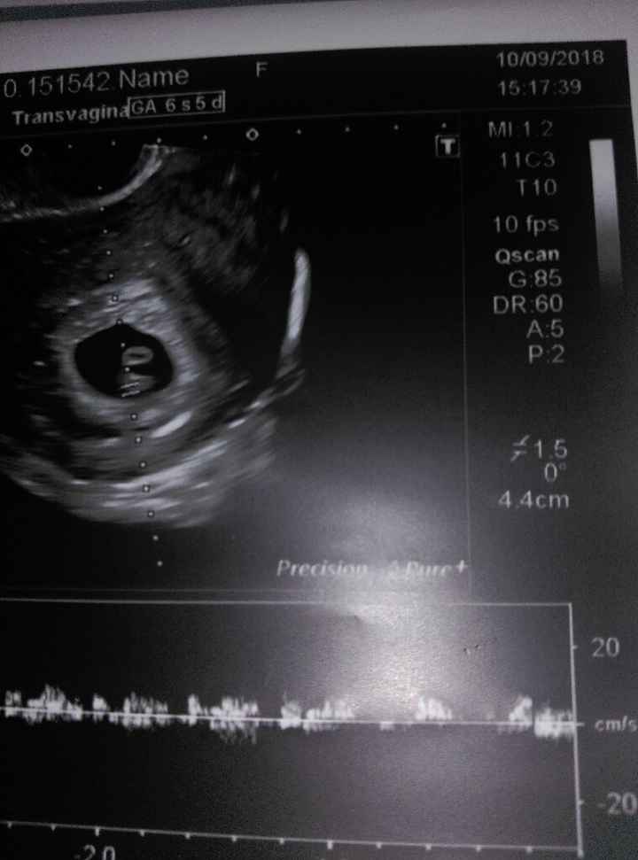 Ayuda con método ramzi: niño o niña? - 1